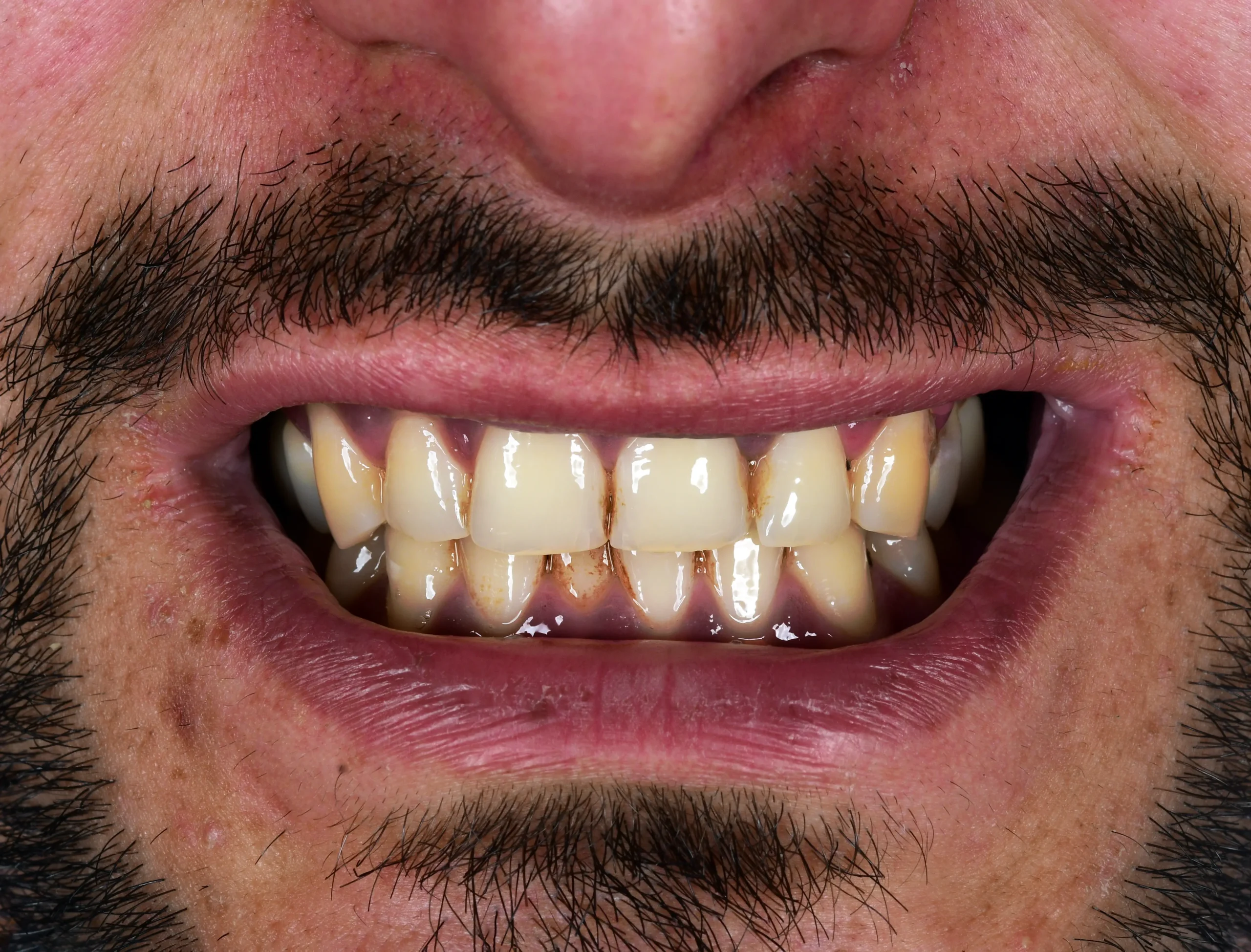 Hollywood Smile Makeover — Vorher