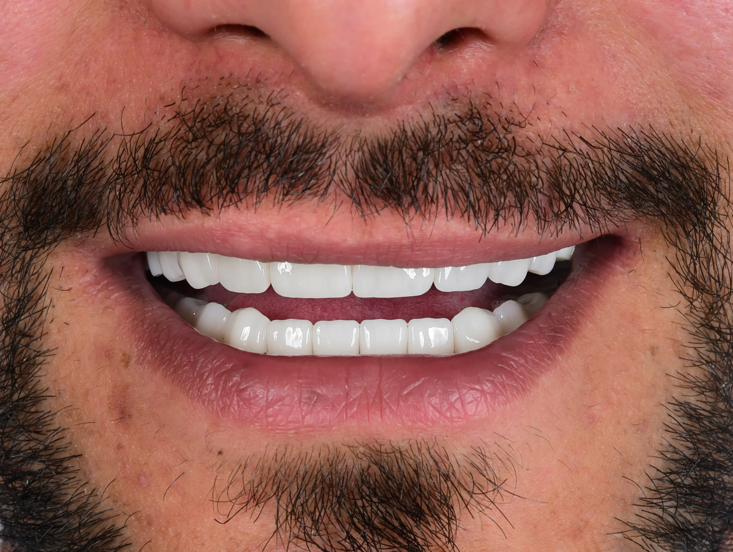 Hollywood Smile Makeover — Nachher
