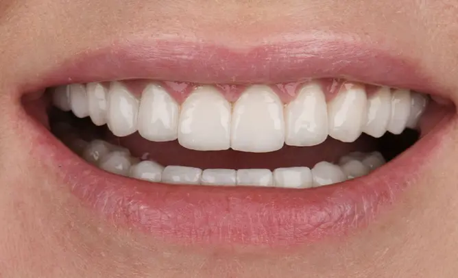 Natürliches Smile Makeover — Nachher