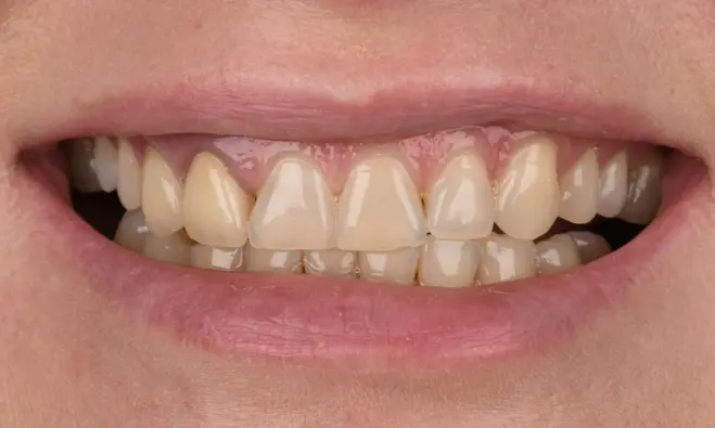 Natürliches Smile Makeover — Vorher