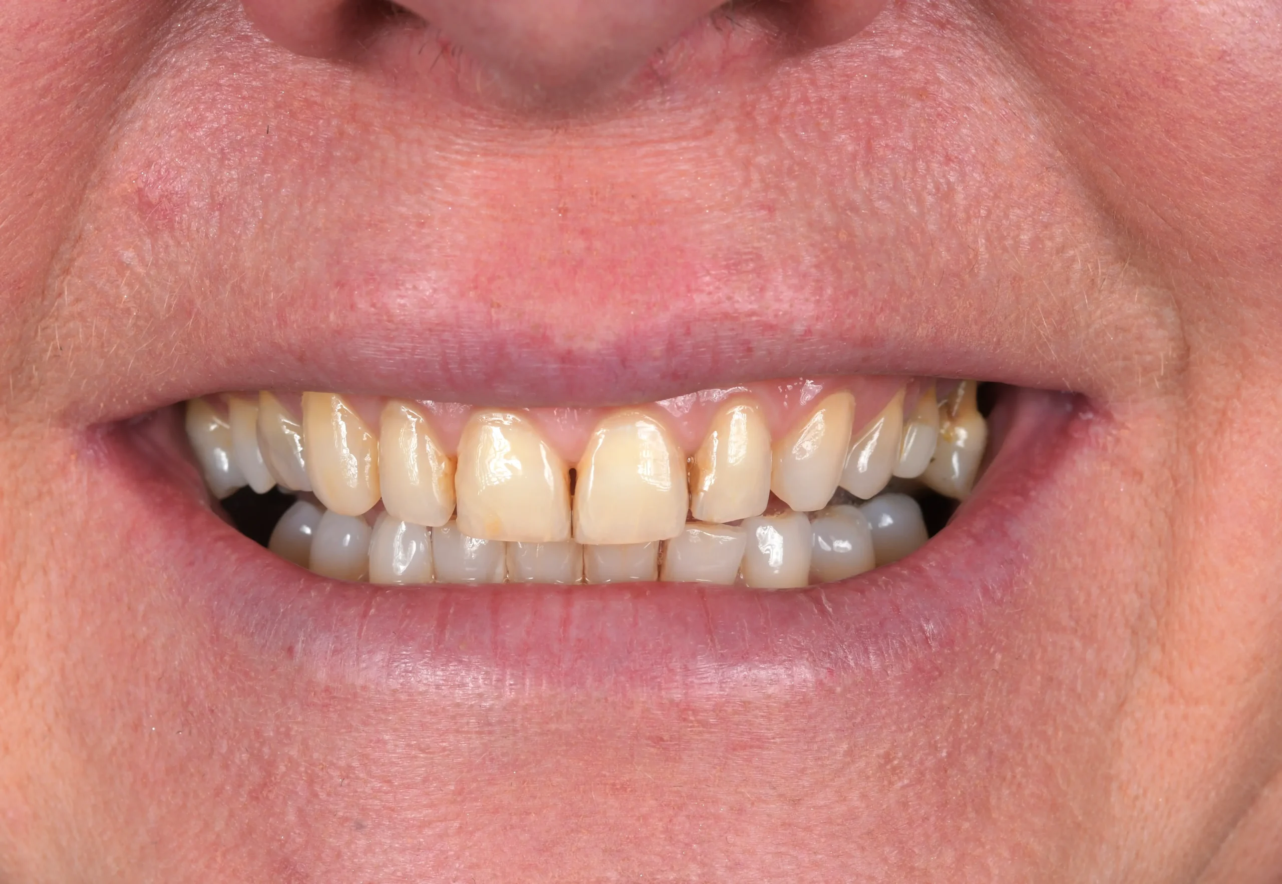 Hollywood Smile Makeover — Vorher