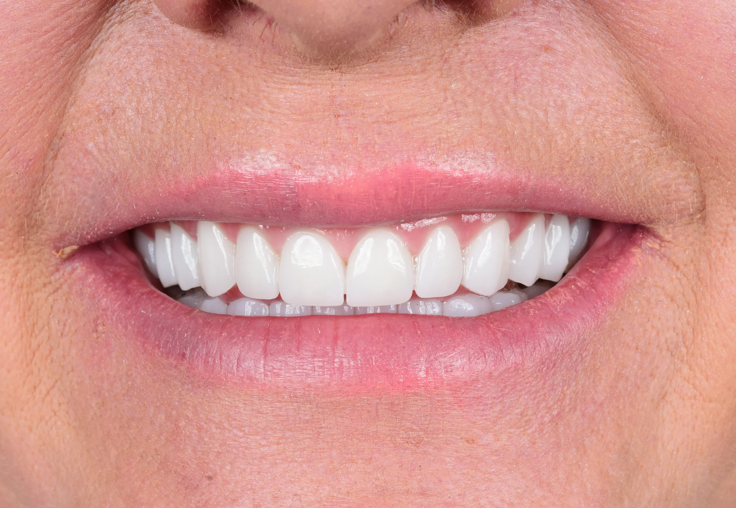 Hollywood Smile Makeover — Nachher