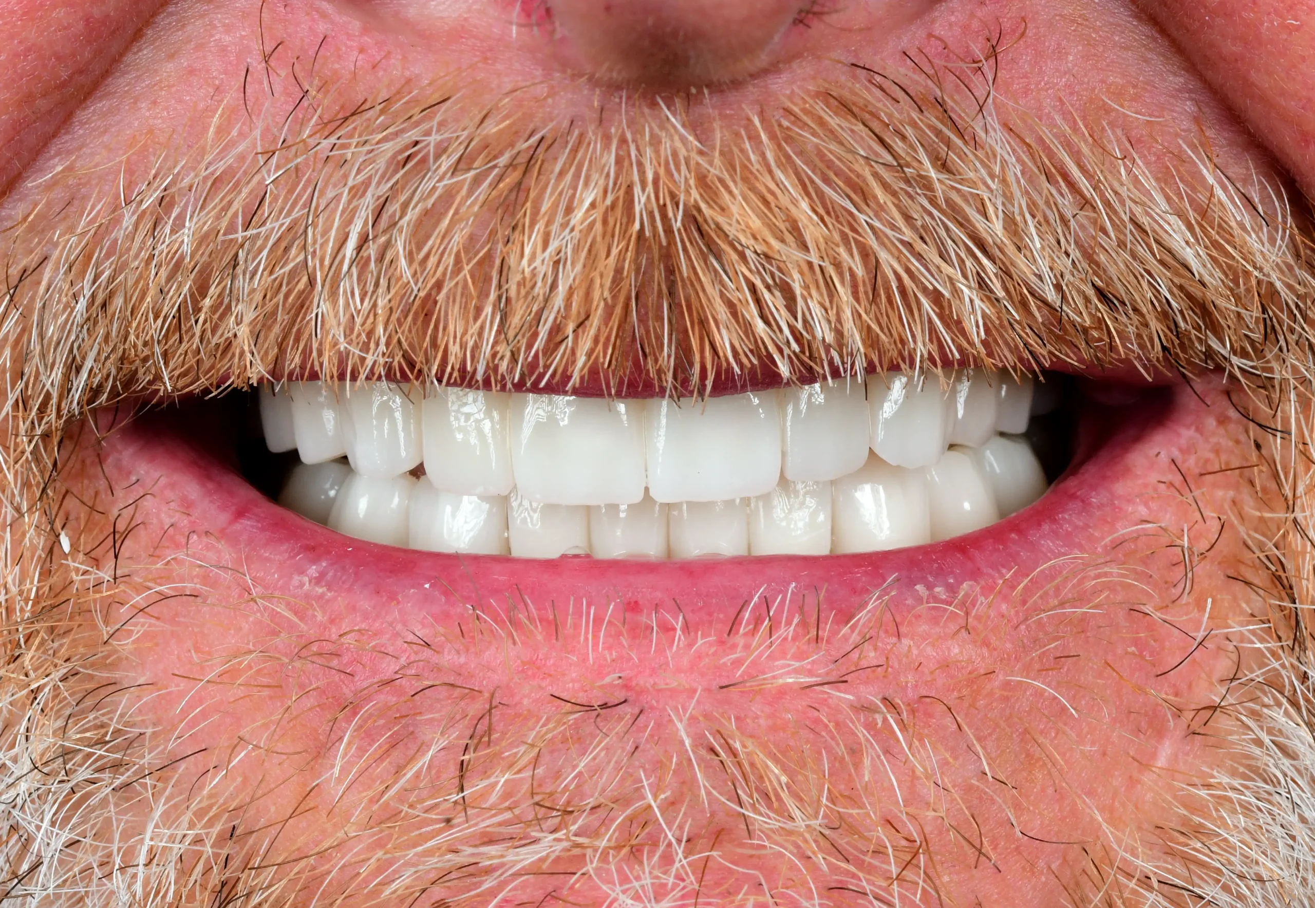 Natürliches Smile Makeover — Nachher
