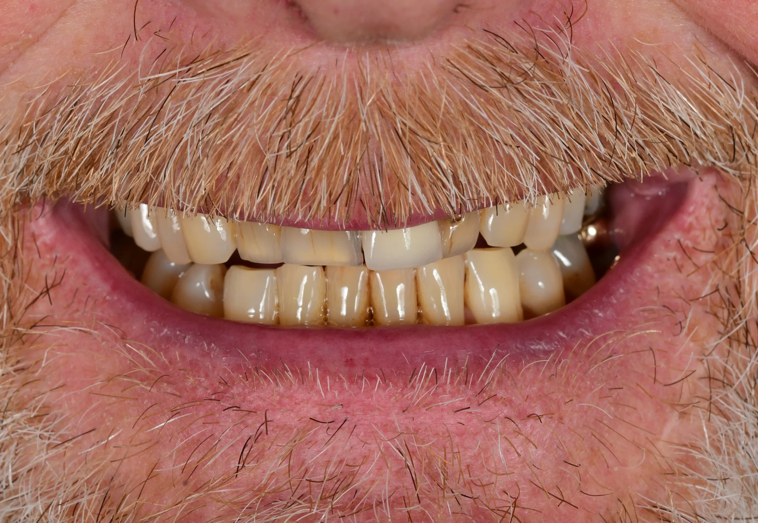 Natürliches Smile Makeover — Vorher
