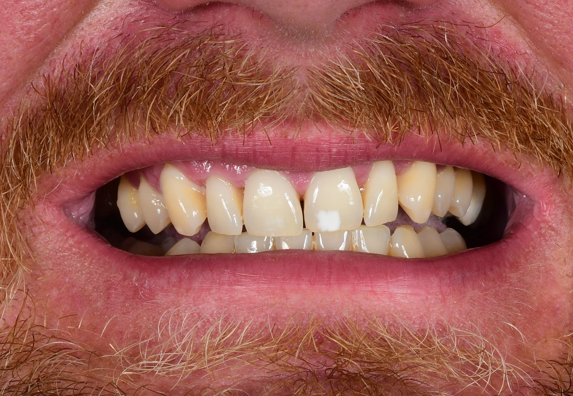 Natürliches Smile Makeover — Vorher