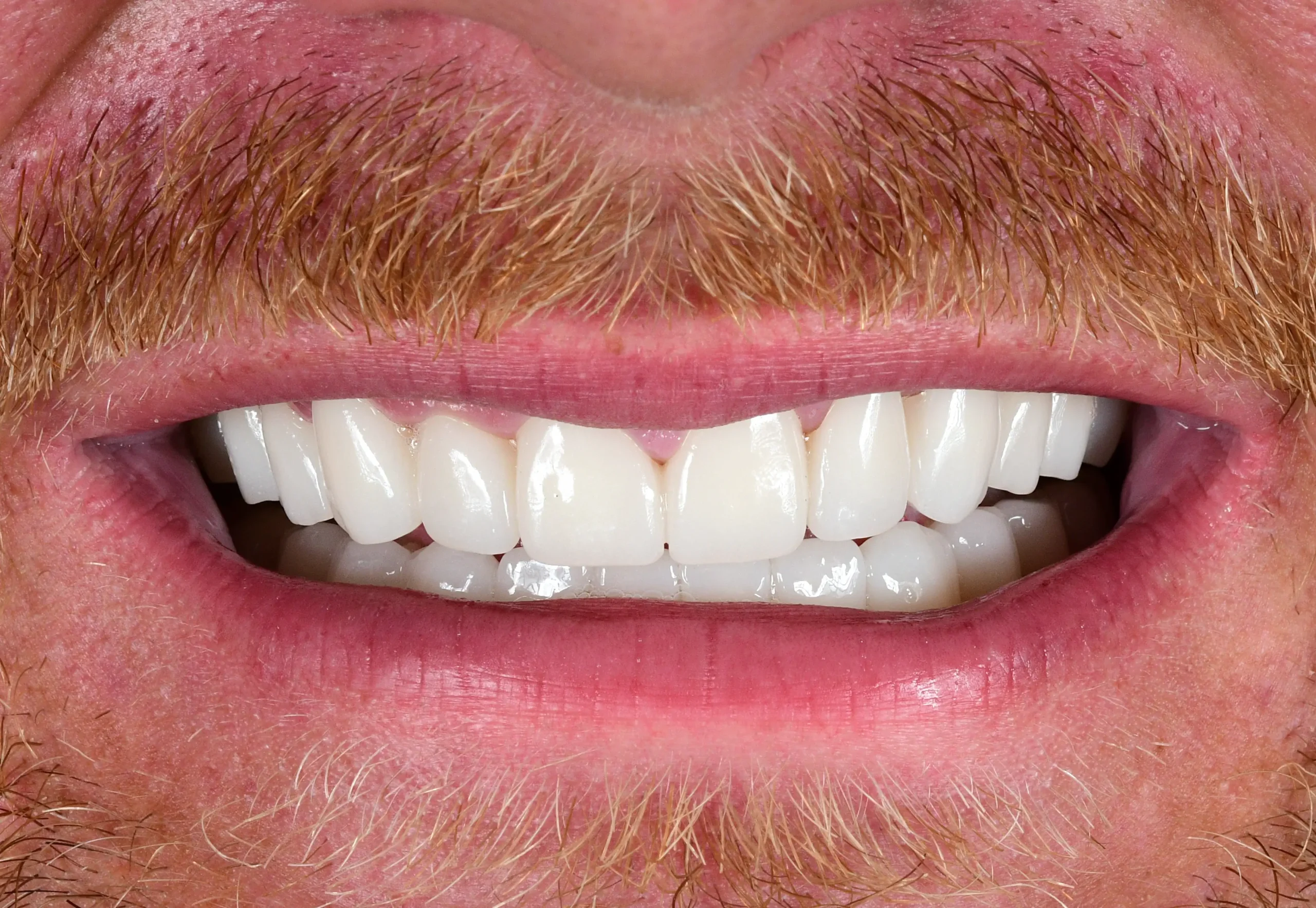 Natürliches Smile Makeover — Nachher