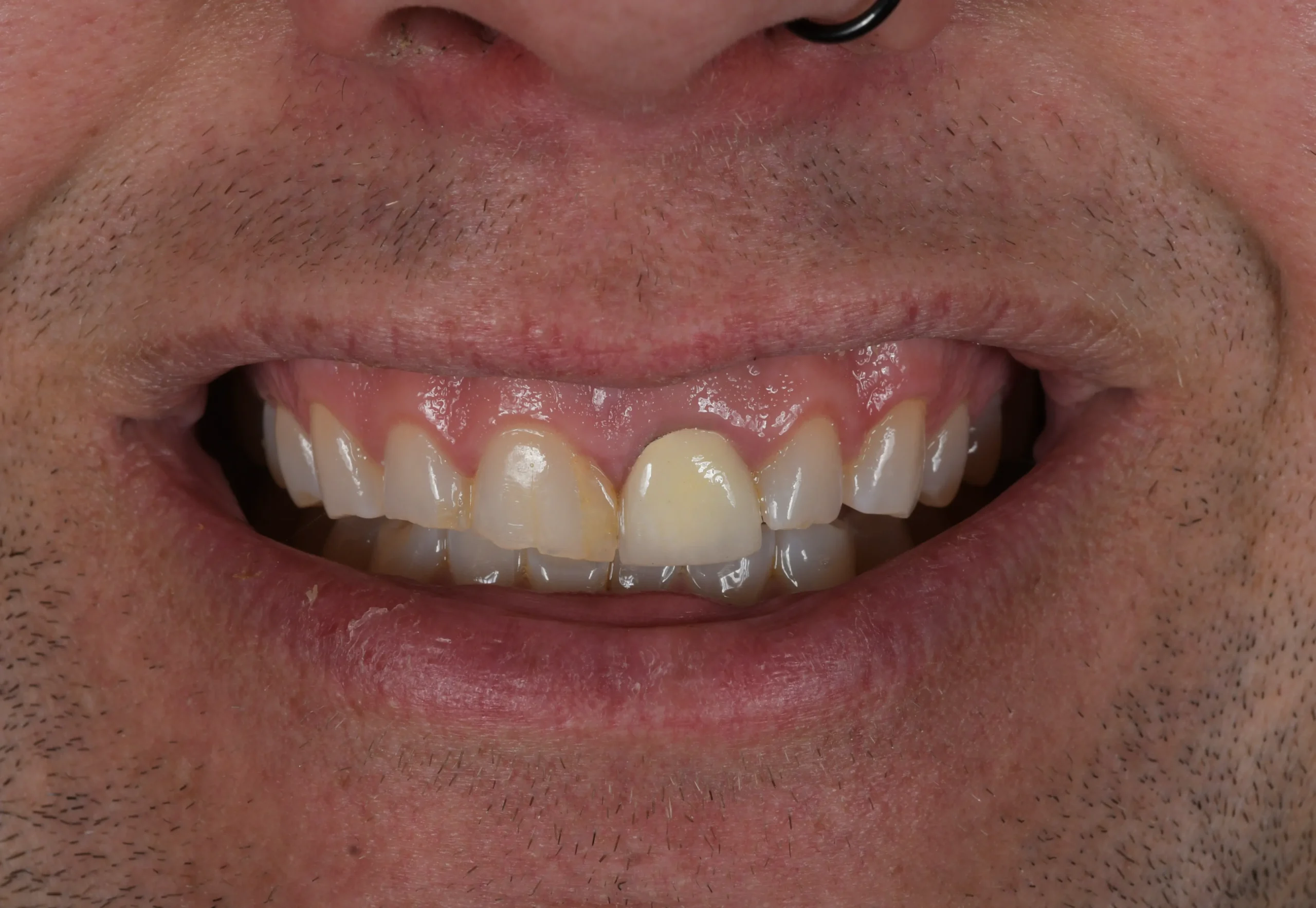 Hollywood Smile Makeover — Vorher