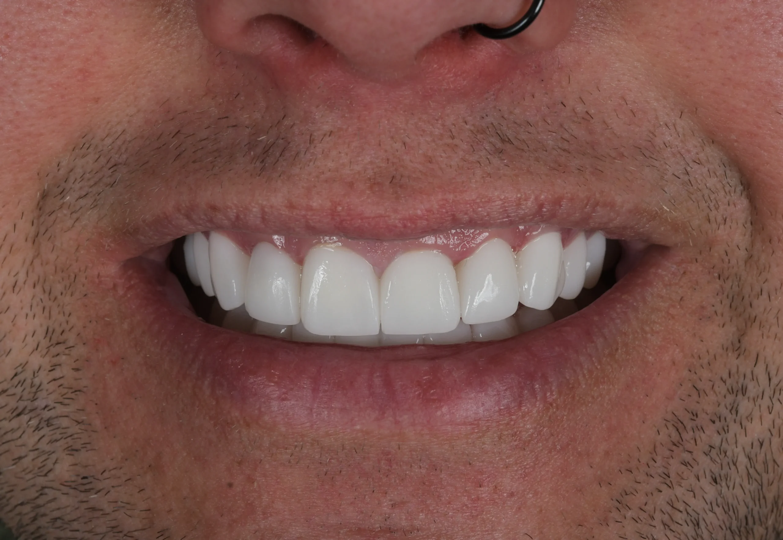 Hollywood Smile Makeover — Nachher