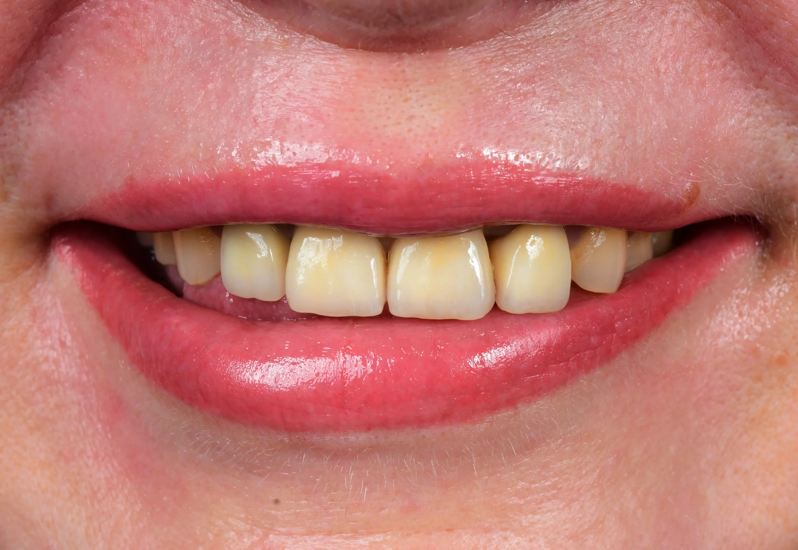 Natürliches Smile Makeover — Vorher