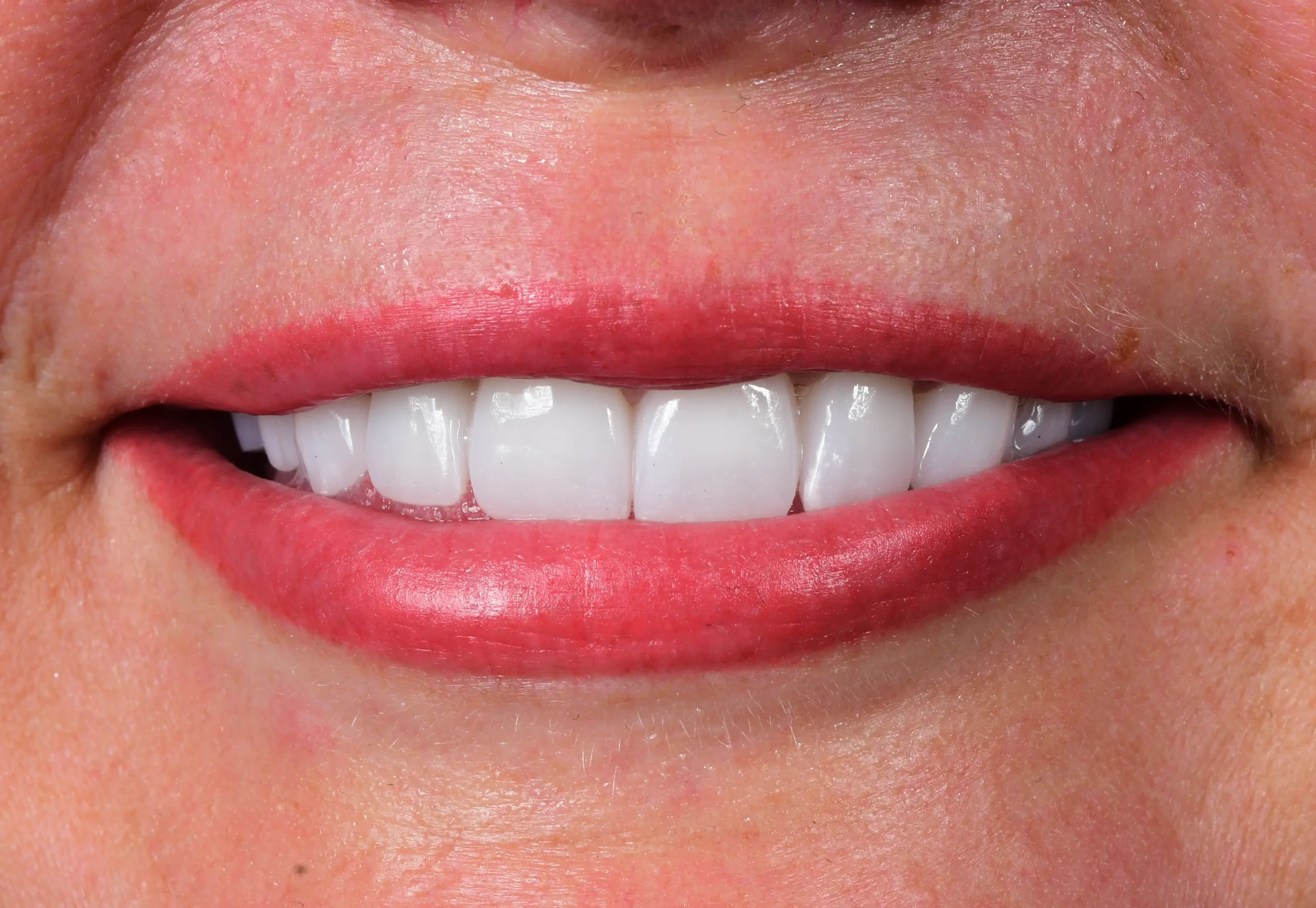 Natürliches Smile Makeover — Nachher