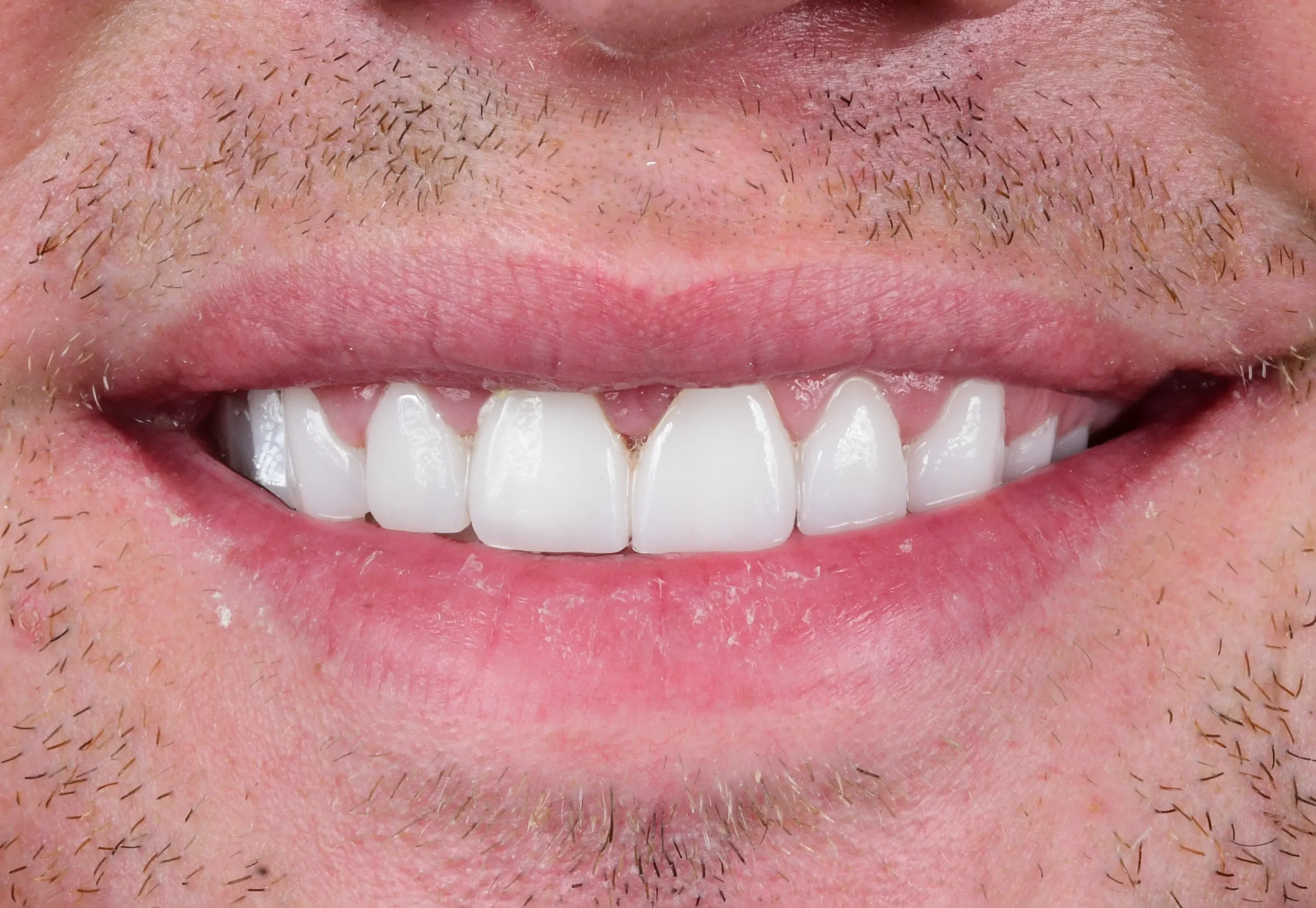 Natürliches Smile Makeover — Nachher