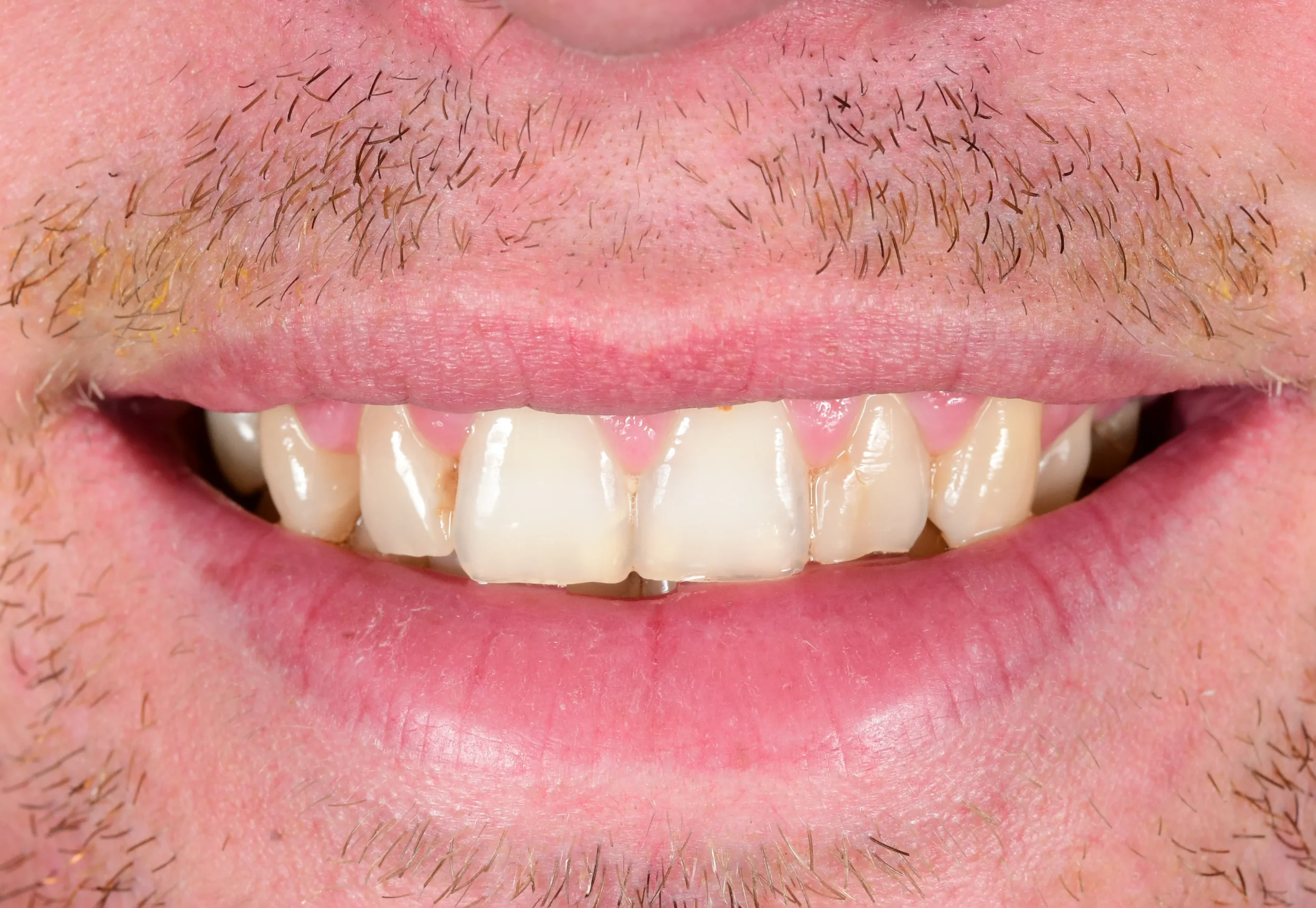 Natürliches Smile Makeover — Vorher