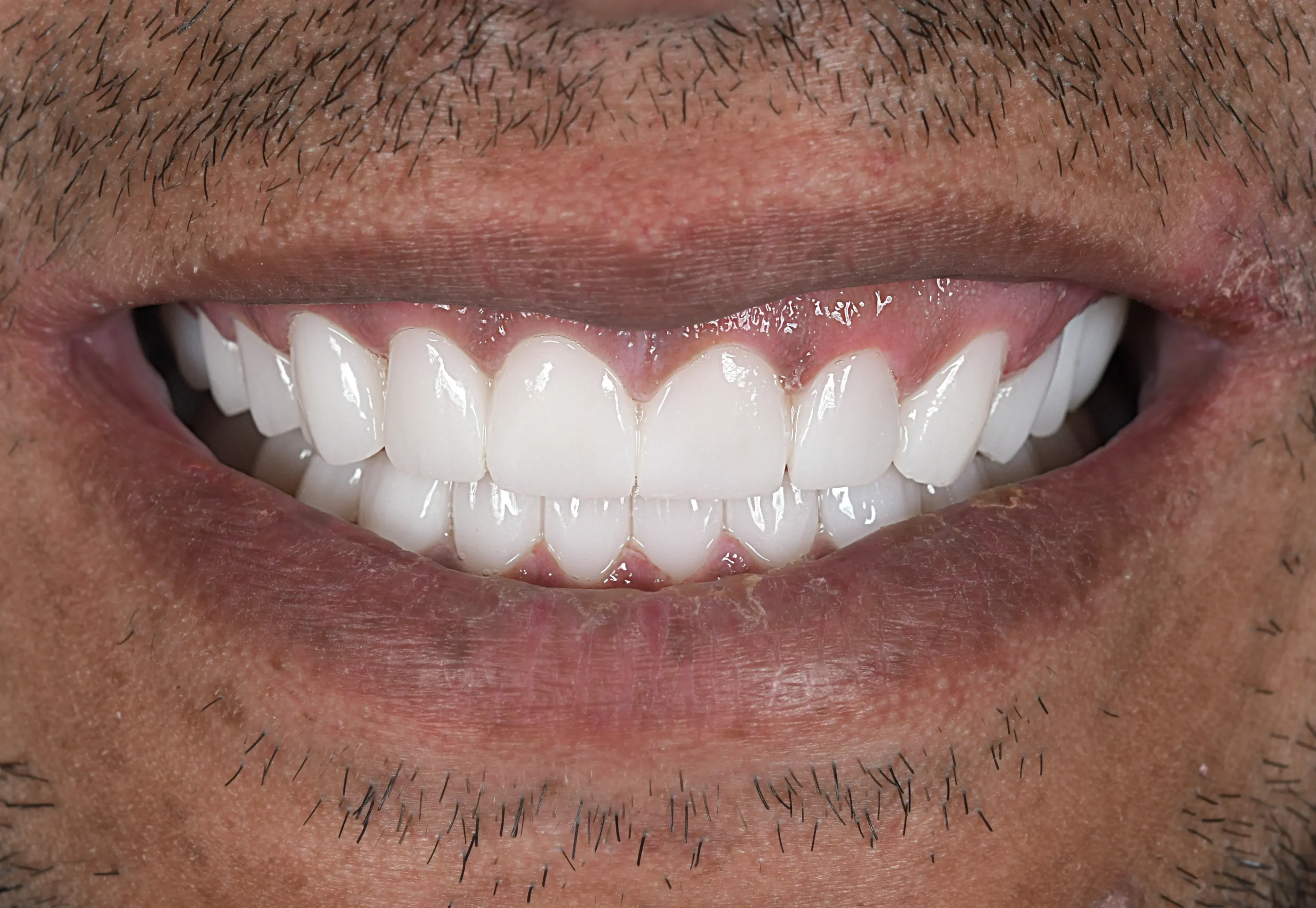 Hollywood Smile Makeover — Nachher
