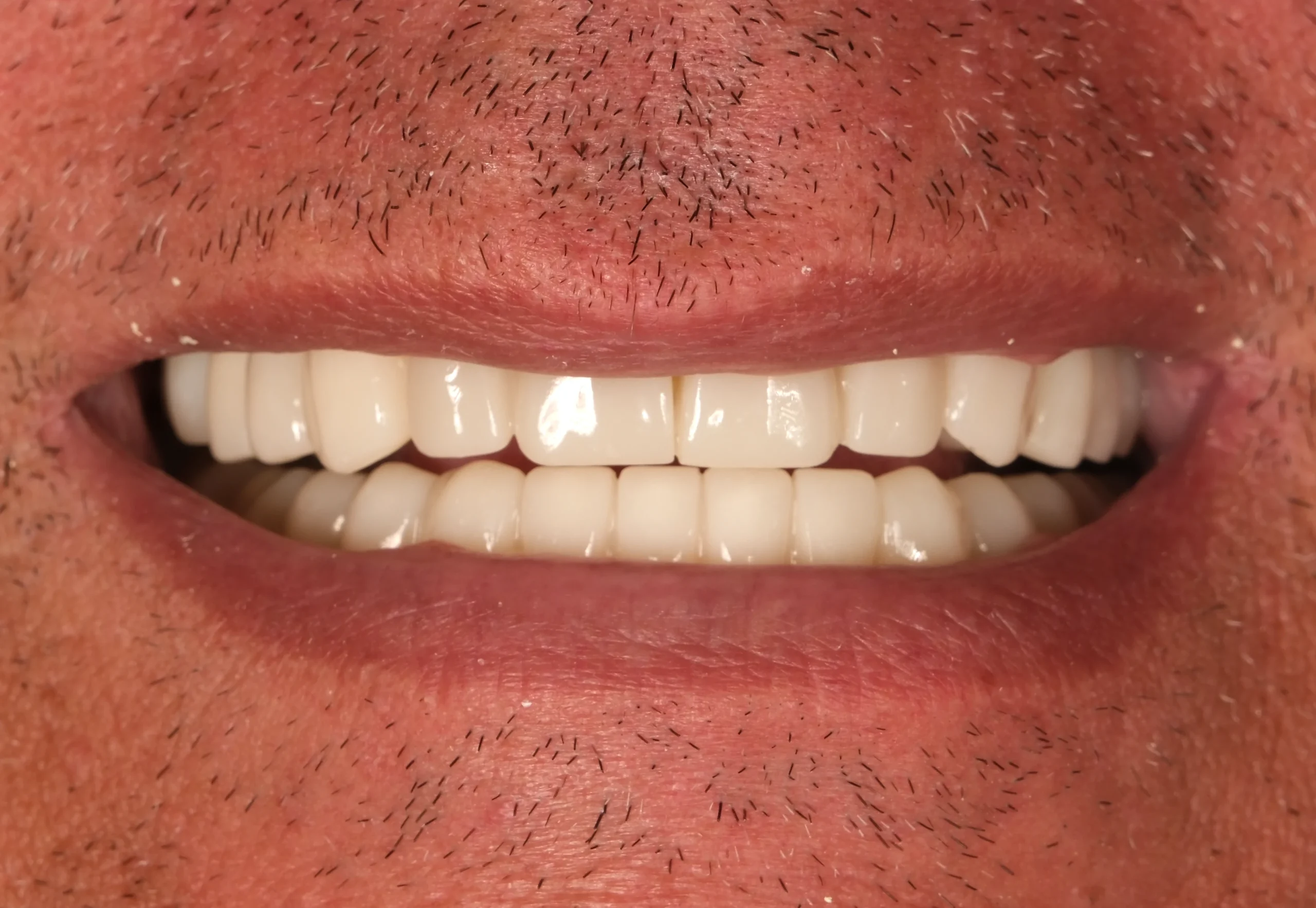 Natürliches Smile Makeover — Nachher