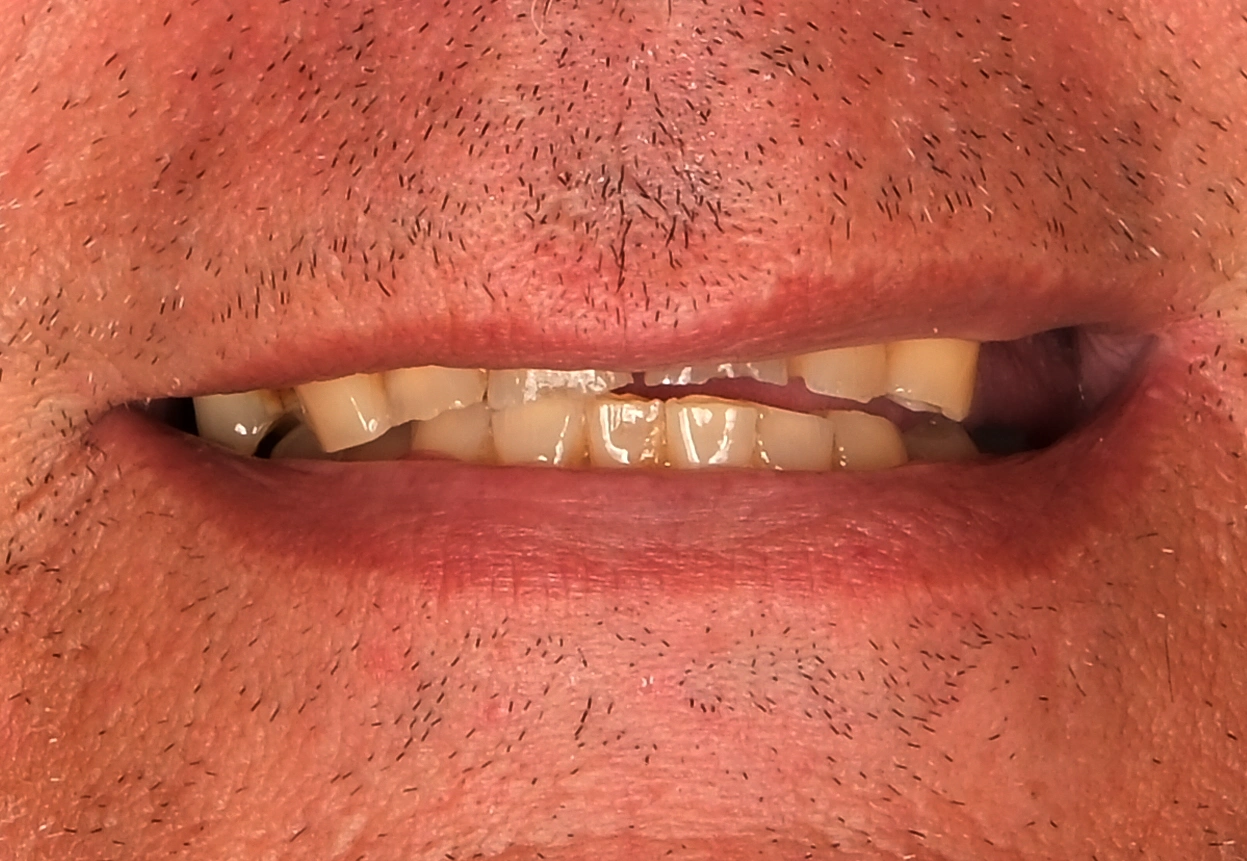 Natürliches Smile Makeover — Vorher