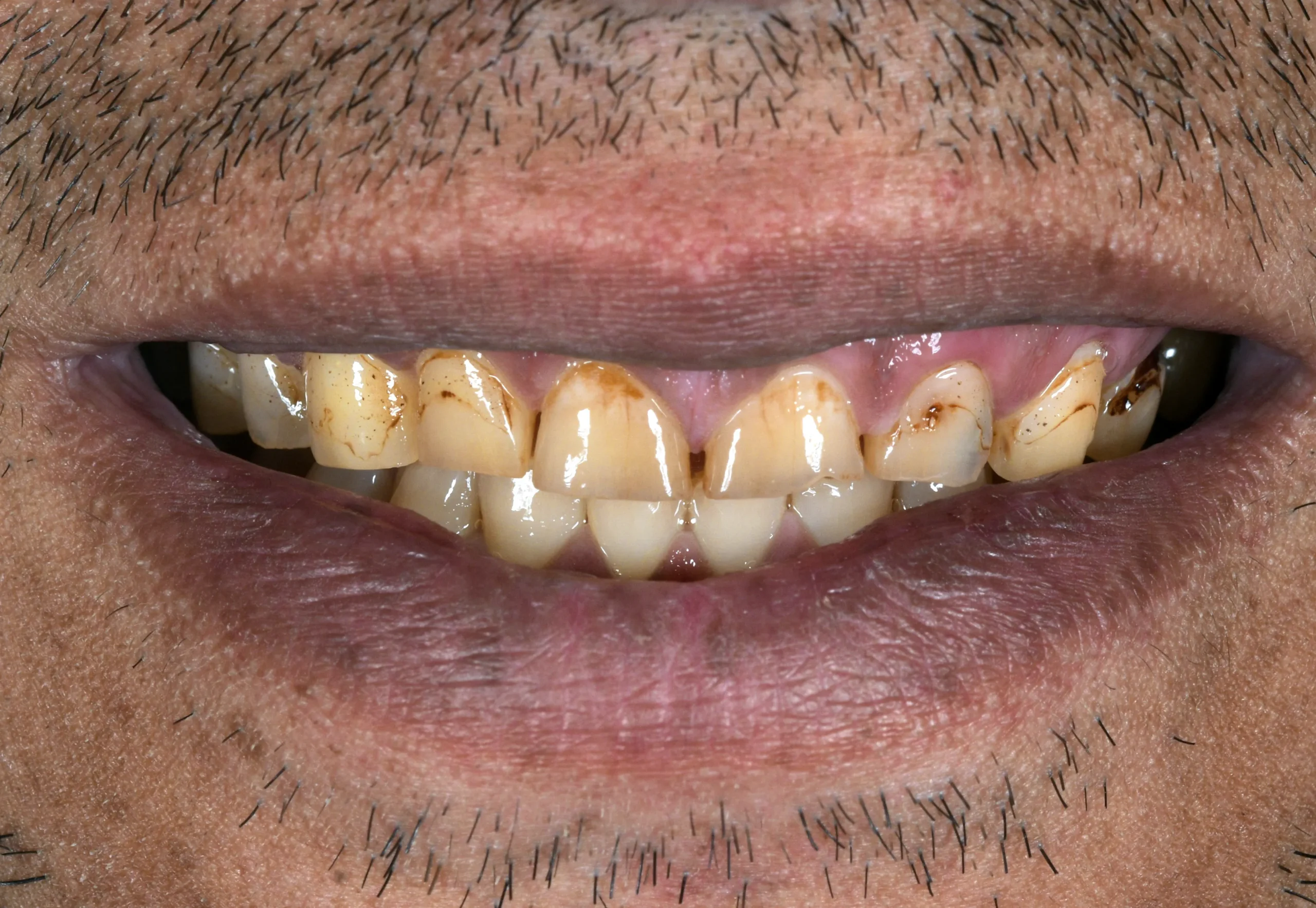 Hollywood Smile Makeover — Vorher