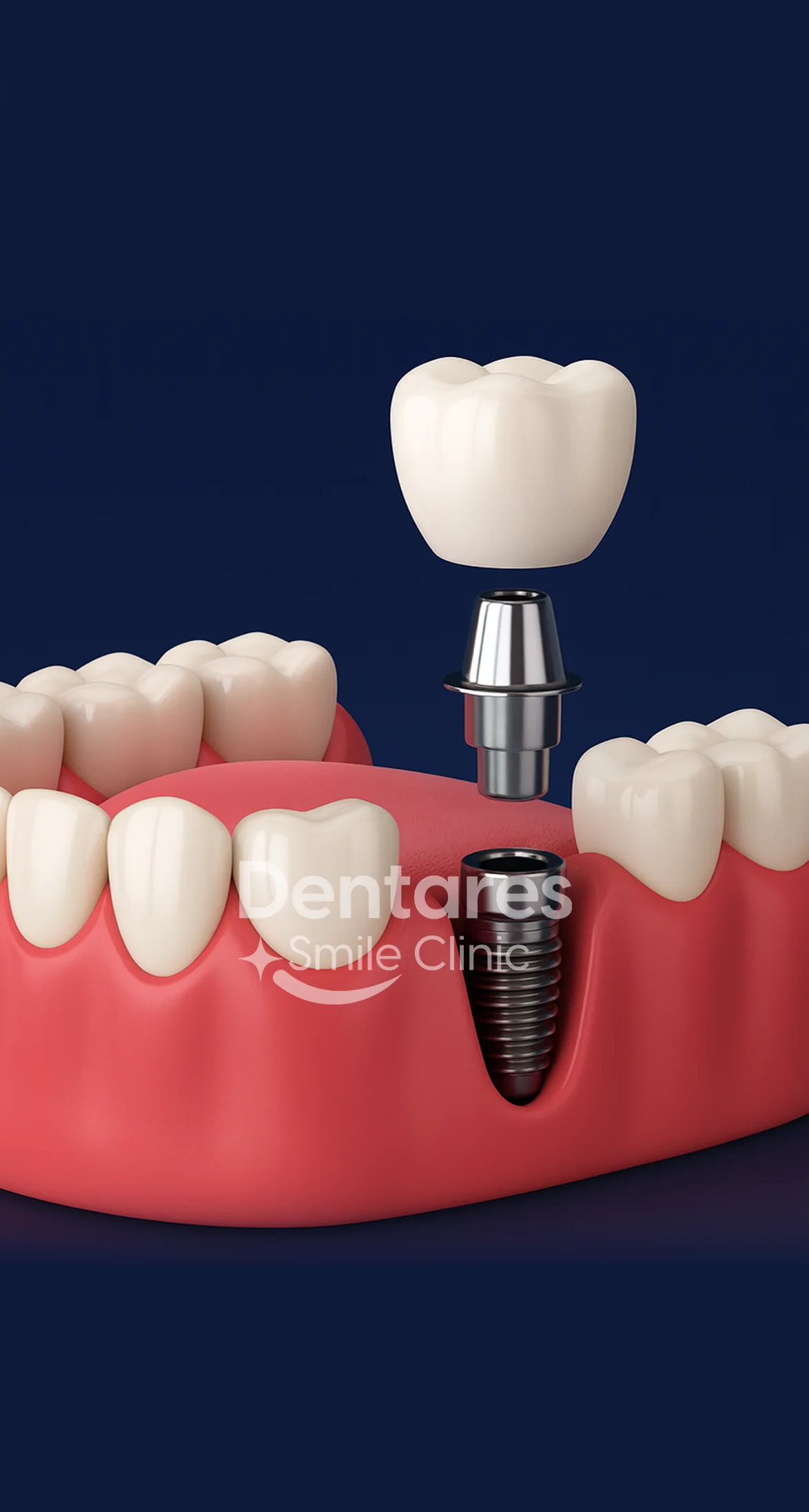 Implantate