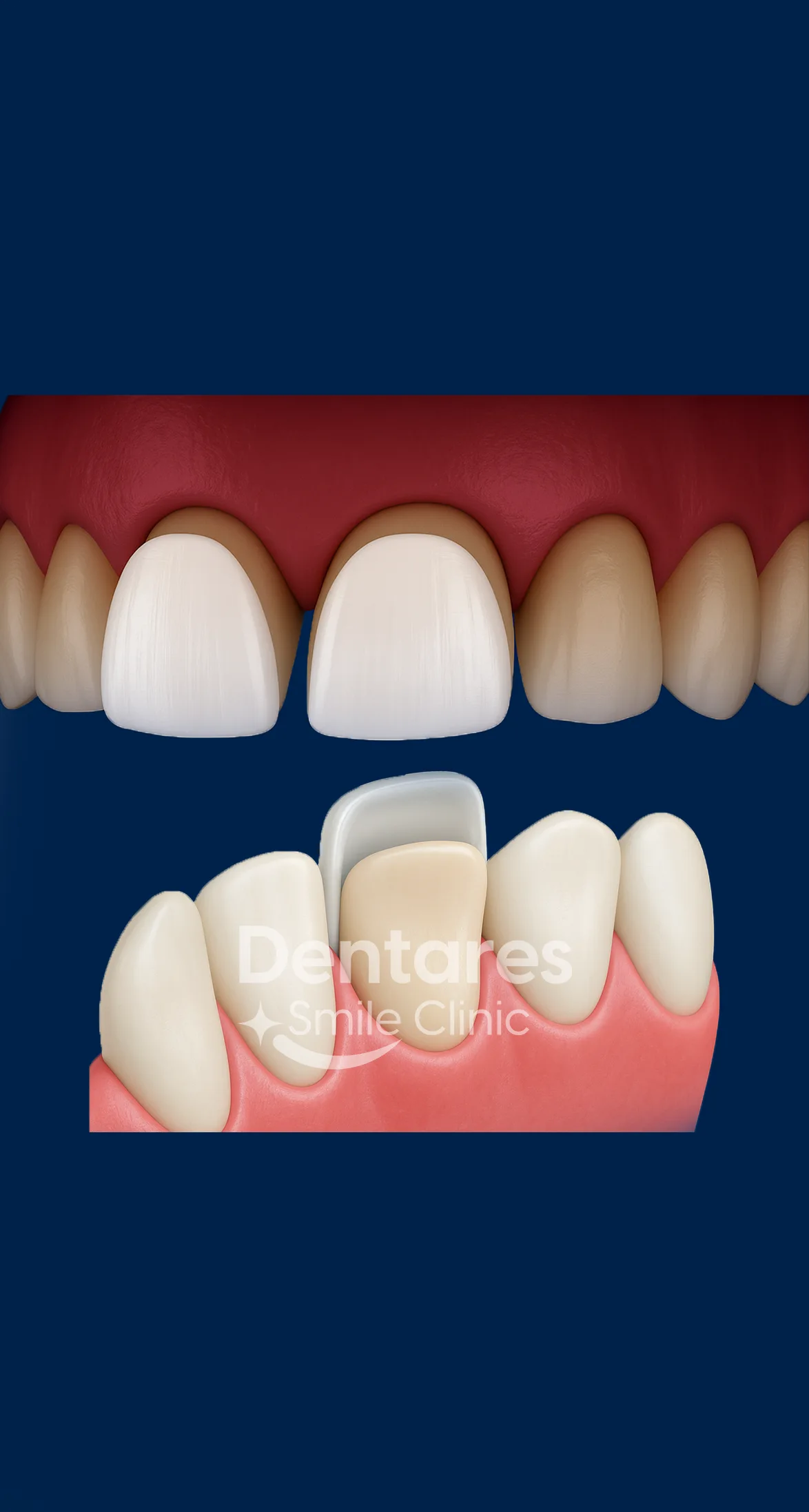 Veneers